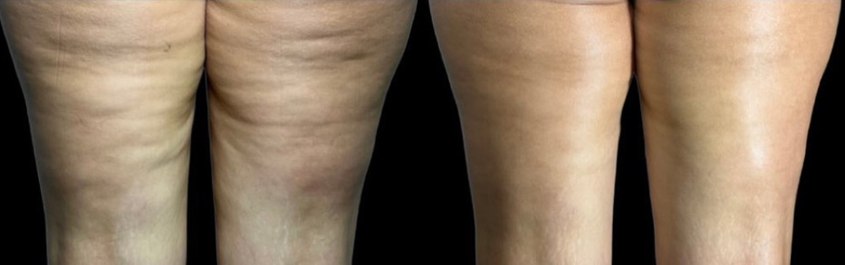 💝 Cellulite✧Contour✨ & Sculpt (Stomach, Thighs or Legs) ~ $200