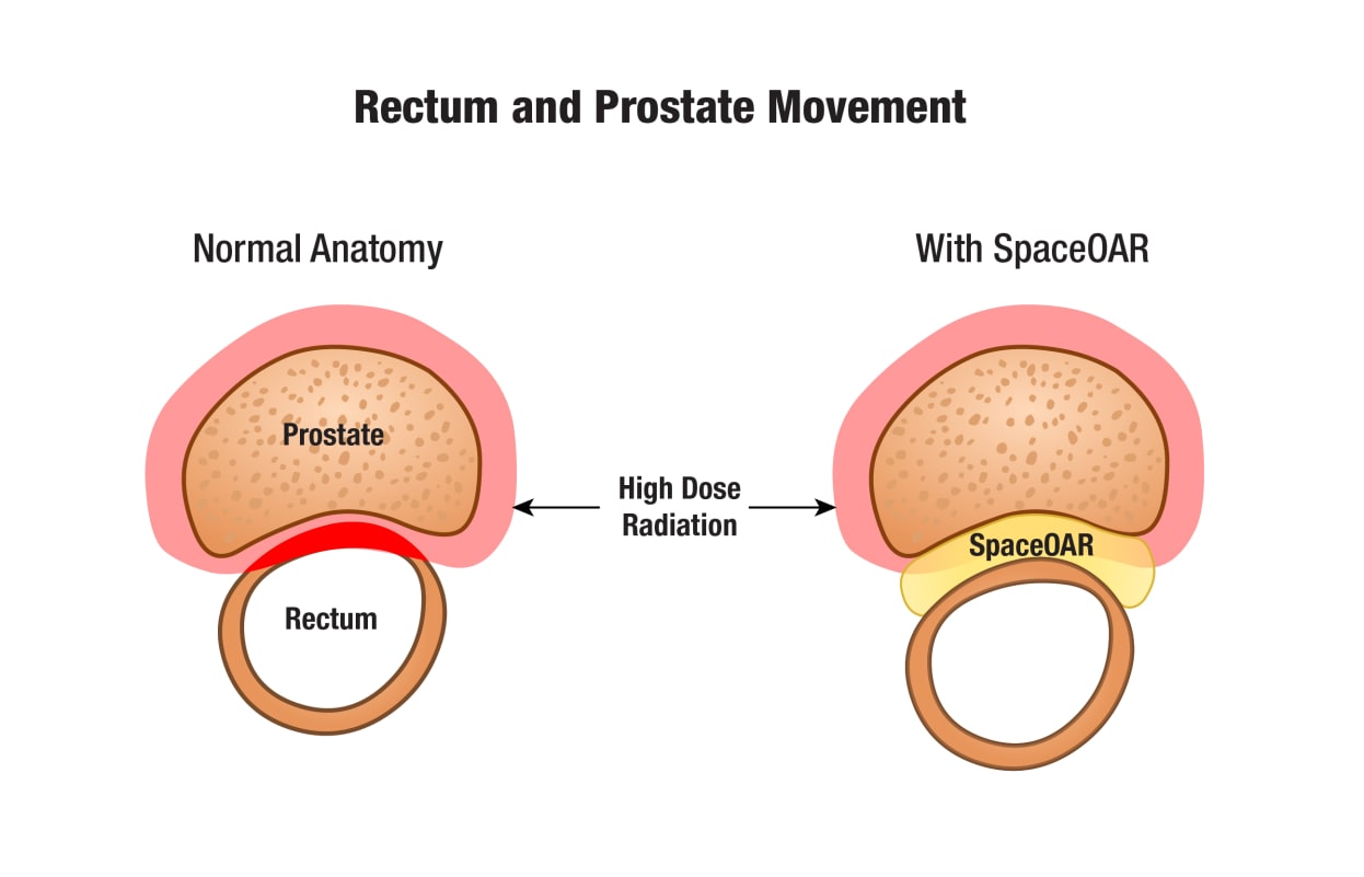 Prostate 5601