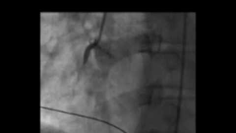 Cath Demo - Angioplasty