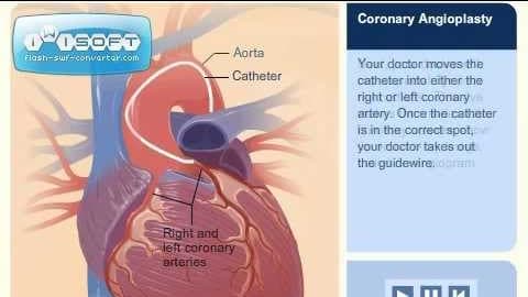 Coronary Angioplasty