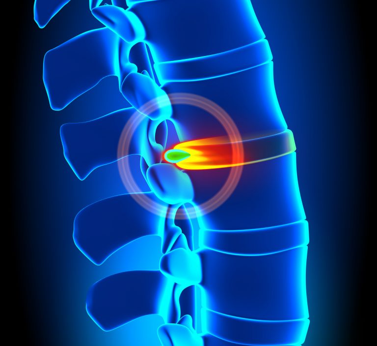 Does A Herniated Disc Always Mean Back Pain?