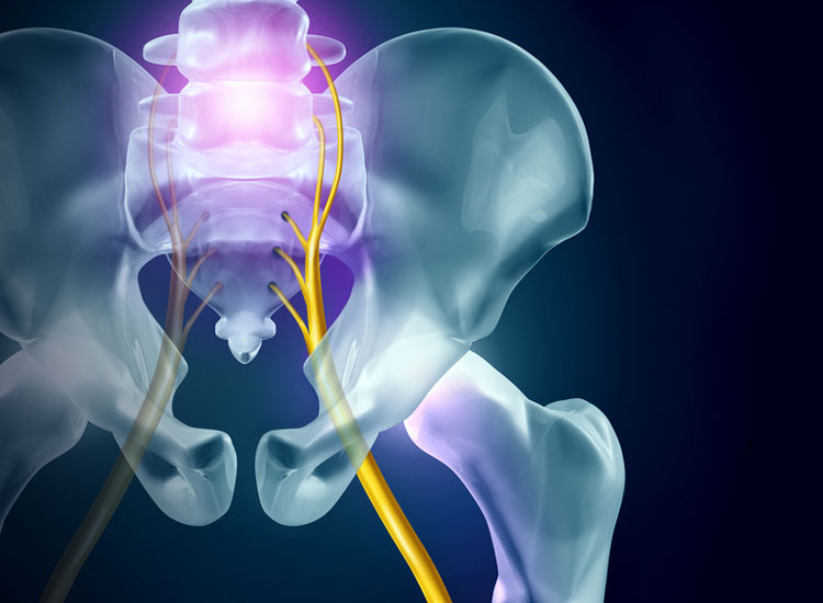 X-Ray of hip and sciatica nerve