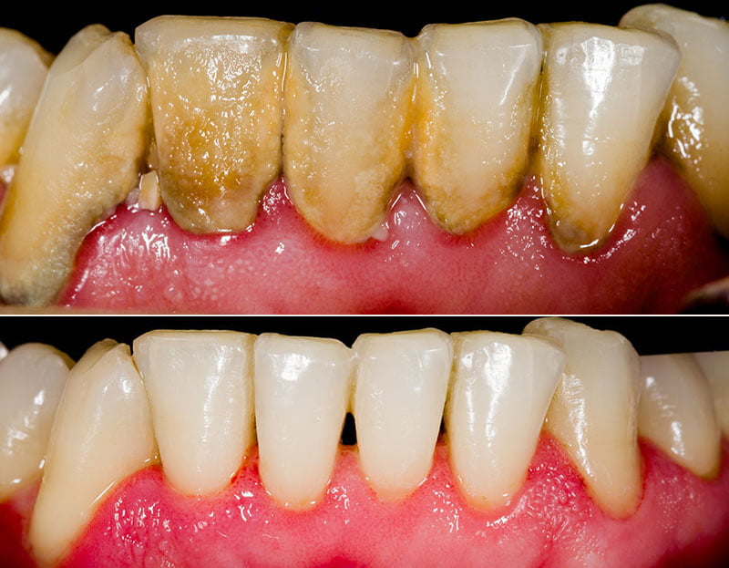 Gingivitis:Symptom, Causes and Management