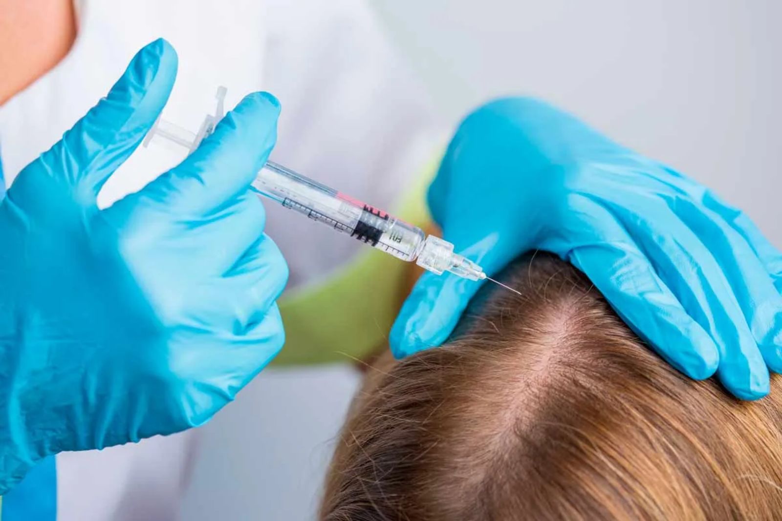 Mesoterapia capilar