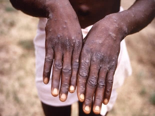 WHO decides not to declare monkeypox a global emergency as cases surge