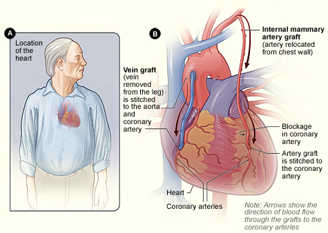 coronary artery bypass operation