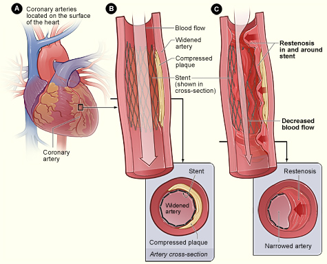 The facts about Angioplasty. The facts about Angioplasty.