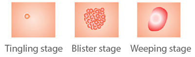 Cold Sore Yellow Crust Stage