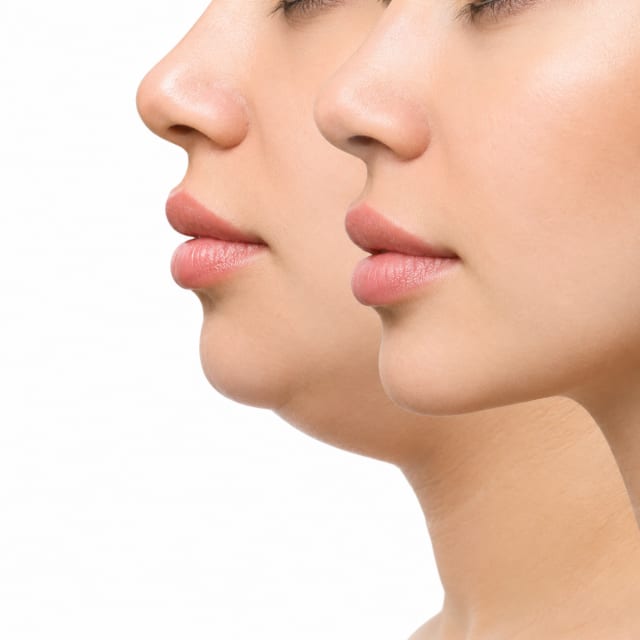Double Chin & Neck Contouring