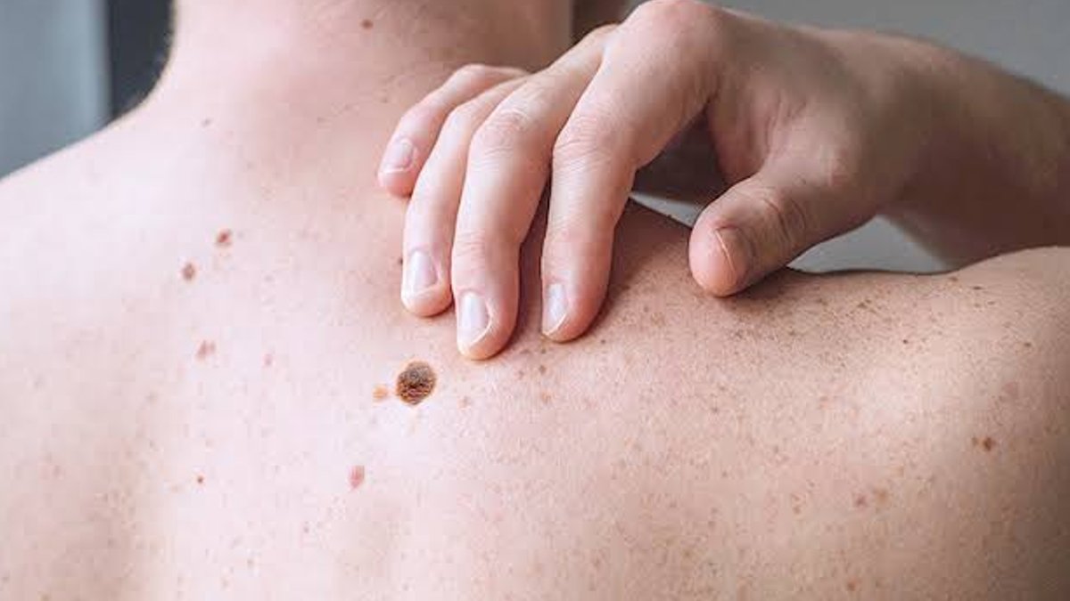 FDA Approves New Melanoma Treatment - melanoma treatment