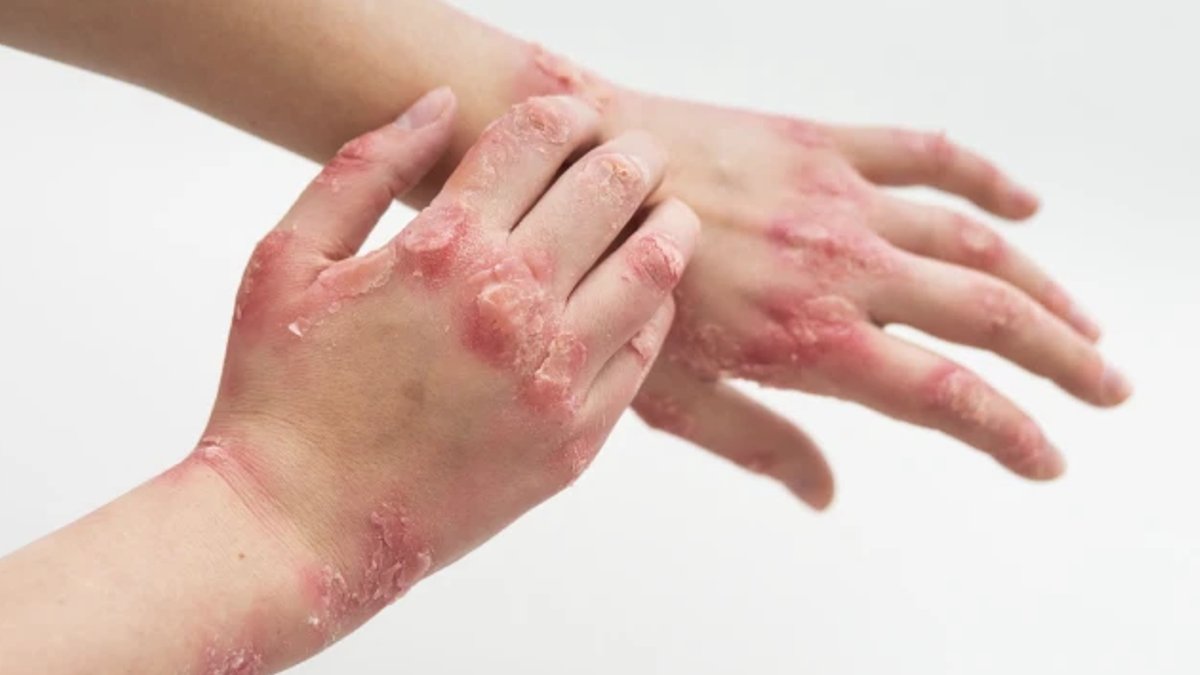 Key Facts on Eczema Revealed for Readers - eczema symptoms