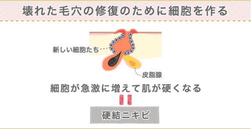 ニキビ跡にしこりが出来るのはなぜ 治すために意識したい3つのポイント