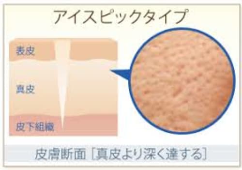 クレーター肌の種類と特徴は 原因と治し方を一挙紹介