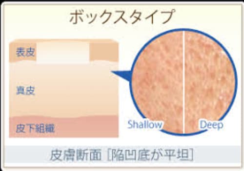 クレーター肌の種類と特徴は 原因と治し方を一挙紹介