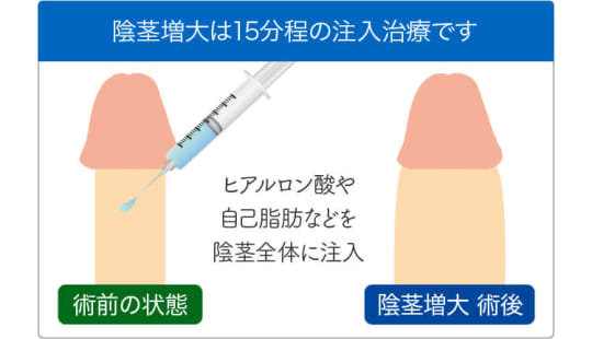 ペニス増大手術