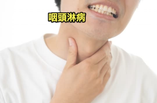 デリヘル　性病　咽頭淋病