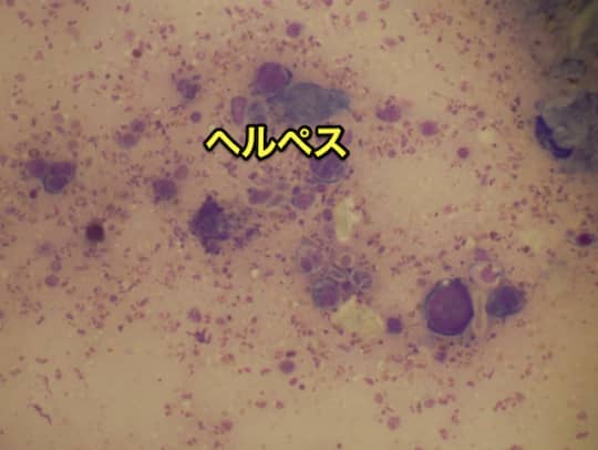 デリヘル　性病　ヘルペス