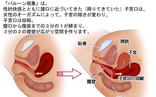 バルーン現象