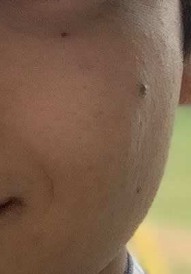 肌荒れが改善した時の肌の様子