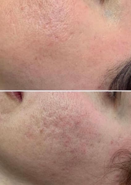 Micorneedling before and after