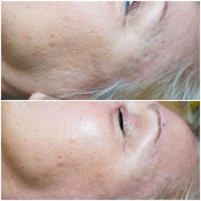Dermaplaning before and after