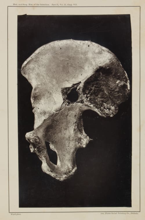 Plate XXXVI Shot Perforation of the Right Ilium Ward, E.J.  (American)