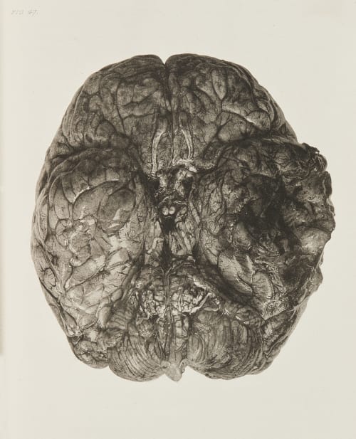 Necrosis of Portion of Brain Annan, James Craig  (Scottish, 1864-1946)