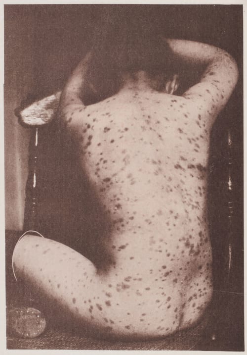 Urticaria Pigmentosa Fox, George Henry  (American, 1846-1937)