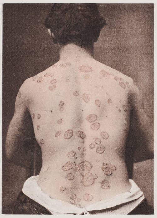 Psoriasis Nummulata Fox, George Henry  (American, 1846-1937)