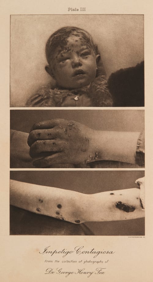 Plate III Impetigo Contagiosa Fox, George Henry  (American, 1846-1937)