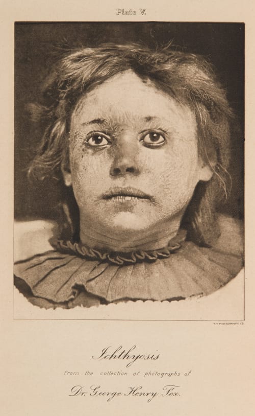 Plate V Ichthyosis Fox, George Henry  (American, 1846-1937)