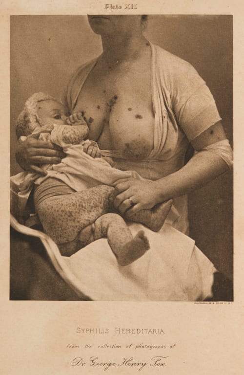Plate XII Syphilis Haereditaria Fox, George Henry  (American, 1846-1937)