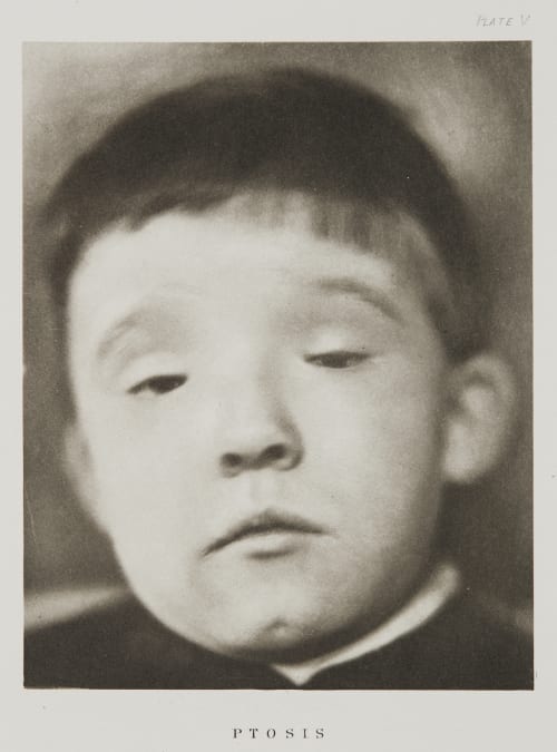 Plate V, Ptosis Ramsay, A Maitland  (Scottish, 1859-1946)