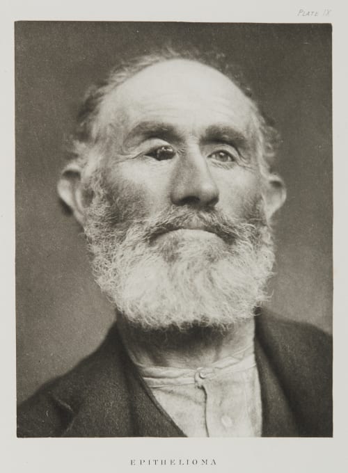 Plate IX, Epithelioma Ramsay, A Maitland  (Scottish, 1859-1946)