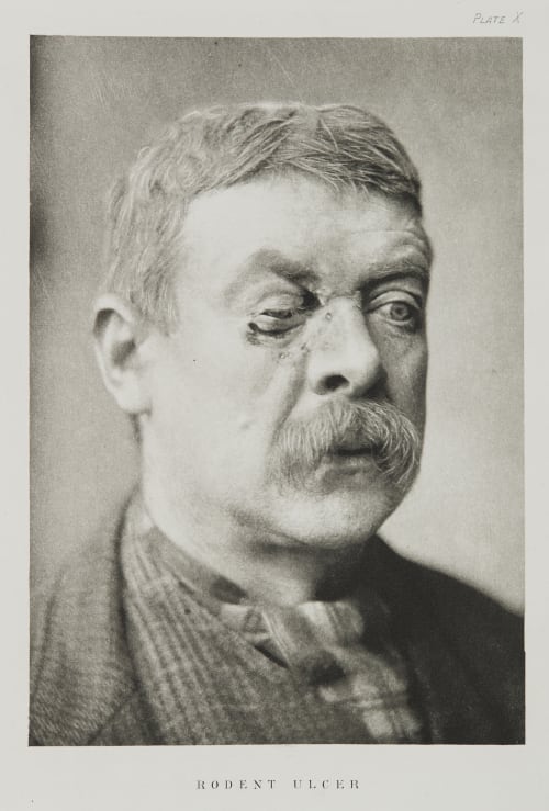 Plate X, Rodent Ulcer Ramsay, A Maitland  (Scottish, 1859-1946)