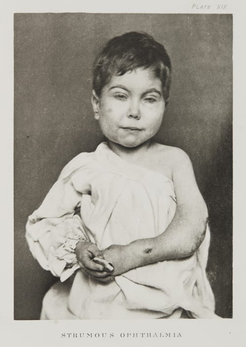Plate XIX, Strumous Ophthalmia Ramsay, A Maitland  (Scottish, 1859-1946)