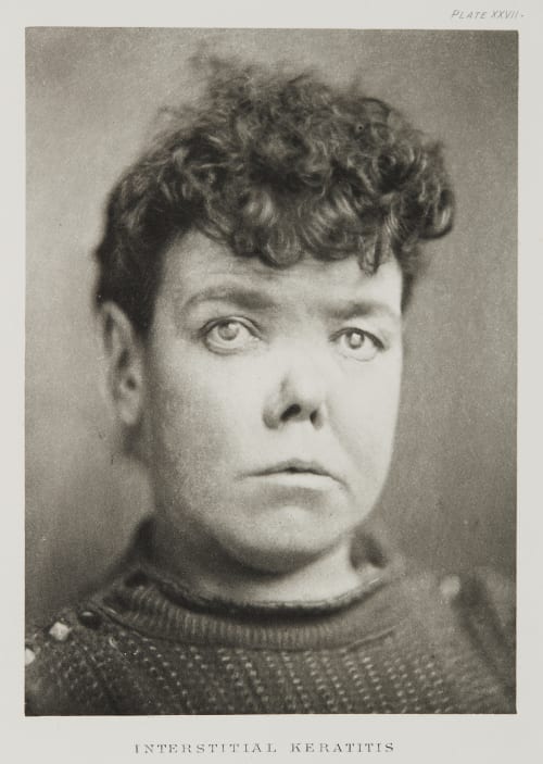 Plate XXVII, Interstitial Keratitis Ramsay, A Maitland  (Scottish, 1859-1946)