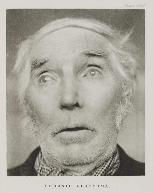 Plate XXXVI, Chronic Glaucoma Ramsay, A Maitland  (Scottish, 1859-1946)