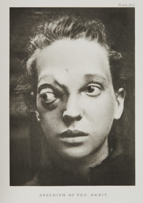 Plate XLII, Aneurism of the Orbit Ramsay, A Maitland  (Scottish, 1859-1946)