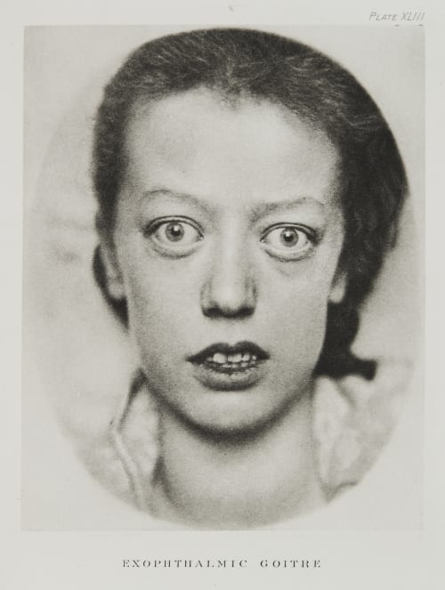 Plate XLIII, Exophthalmic Goitre Ramsay, A Maitland  (Scottish, 1859-1946)
