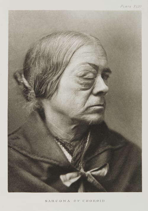 Plate XLVI, Sarcoma of the Choroid Ramsay, A Maitland  (Scottish, 1859-1946)