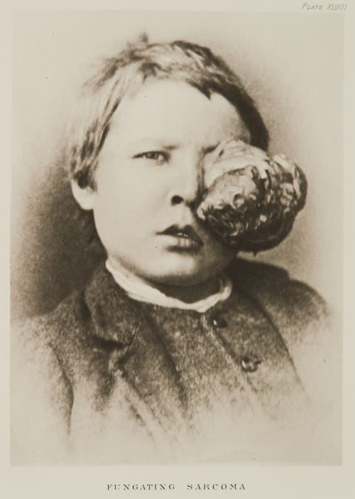 Plate XLVIII, Fungating Sarcoma Ramsay, A Maitland  (Scottish, 1859-1946)