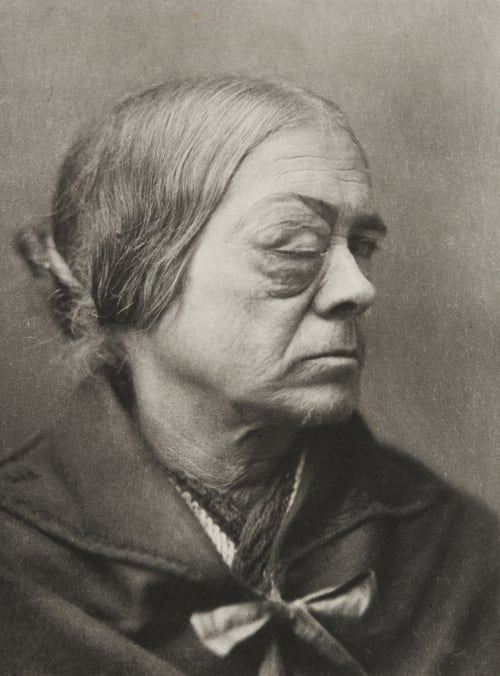 Plate XLVI, Sarcoma of the Choroid Ramsay, A Maitland  (Scottish, 1859-1946)