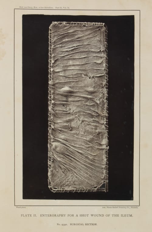 Plate I.  Rupture of the Jejunum by the kick of a horse. Ward, E.J.  (American)