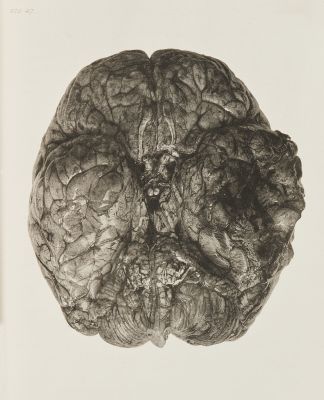 Necrosis of Portion of Brain