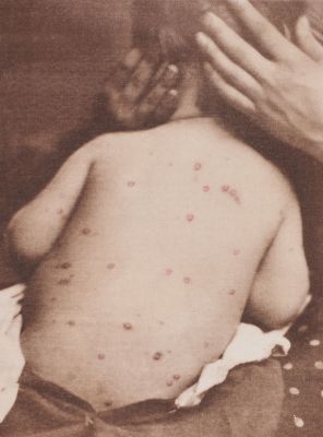 Varicella