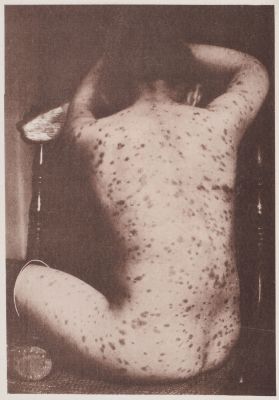 Urticaria Pigmentosa