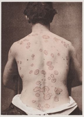 Psoriasis Nummulata