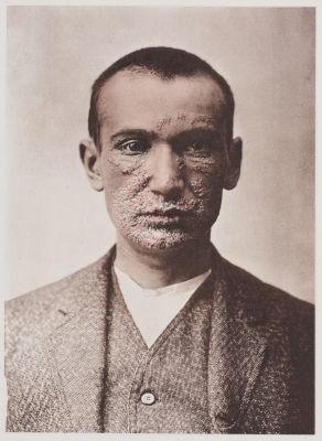 Herpes Facialis