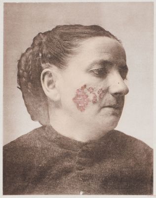 Lupus Vulgaris